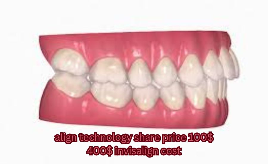 align technology share price 100 400 invisalign cost